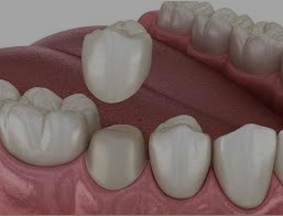 dental crowns clarence ny