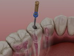 root canal clarence ny